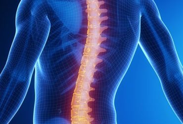 SCOLIOSIS-SQUARE